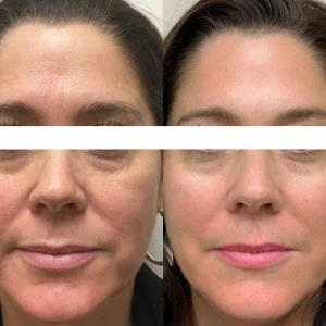 ACUPUNTURA ESTÈTICA I LIFTIN FACIAL